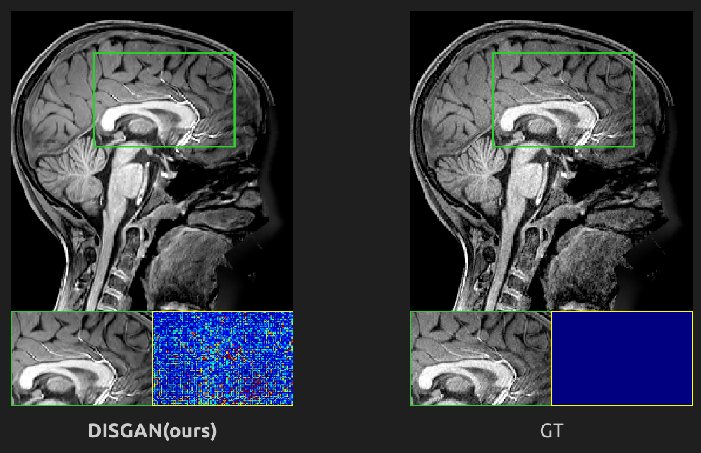 GAN MRI